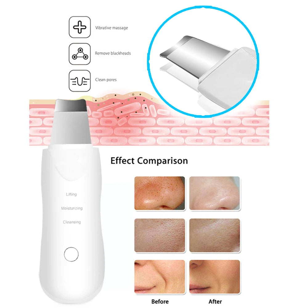 Ultrasonic Skin Scrubber – Deep Vibrate Facial Cleaner & Blackhead Remover